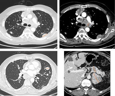 Twenty Years On: RECIST as a Biomarker of Response in Solid Tumours an EORTC Imaging Group – ESOI Joint Paper